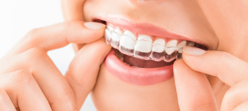 Zahnstellungskorrektur leicht gemacht: Erfahrungen mit der Invisalign Behandlung